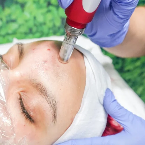 A Deep Dive into Microdermabrasion and How It Exfoliates Skin to Reveal a More Radiant Complexion