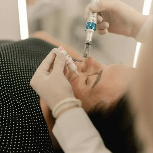 Microneedling: the delicate process, perks, and what to expect
